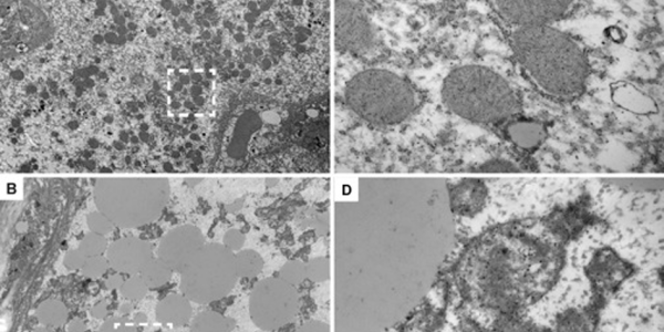 Fialuridine Redux: New Mouse Model Would Have Predicted Fatal Outcome In Human Clinical Trial