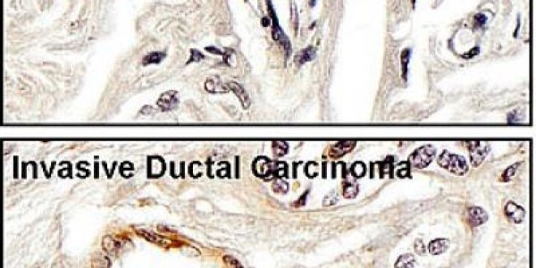 Putting A Brake On Tumor Spread