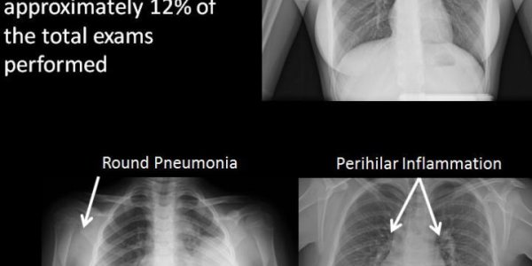 88 Percent Of Chest X-rays Are No Benefit To Children
