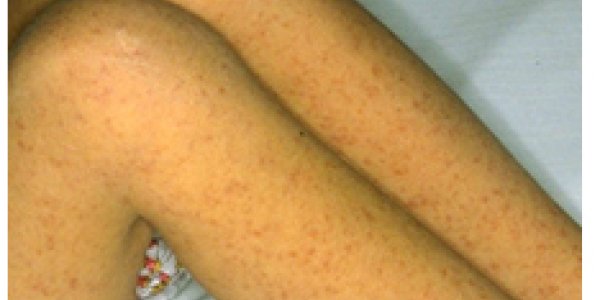 Small Ticks, Big Diseases