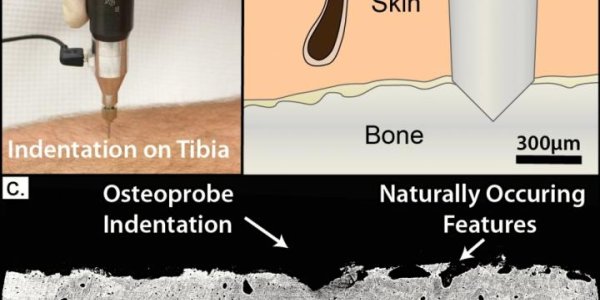 OsteoProbe Tells Good Bone From Bad