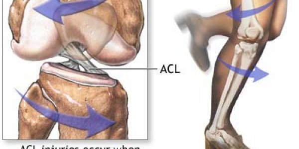 ACL Surgery Is Better Sooner Rather Than Later