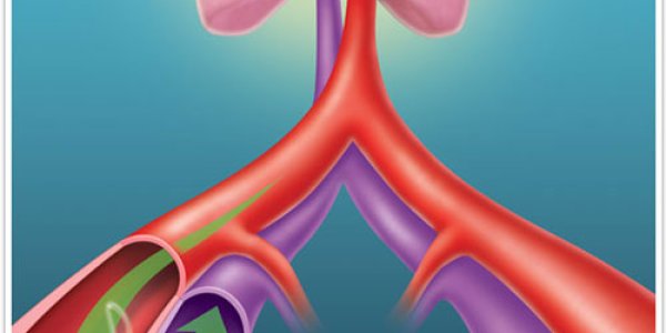 The Coupler - New Implant Lowers Blood Pressure After Outpatient Procedure