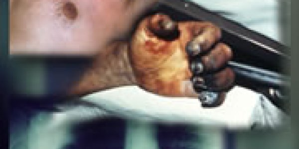 Bioterrorism - Plague As A Biological Weapon