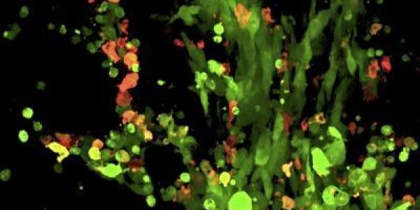 Stealth Cancer: Brain Tumors Fly Under The Body's Radar