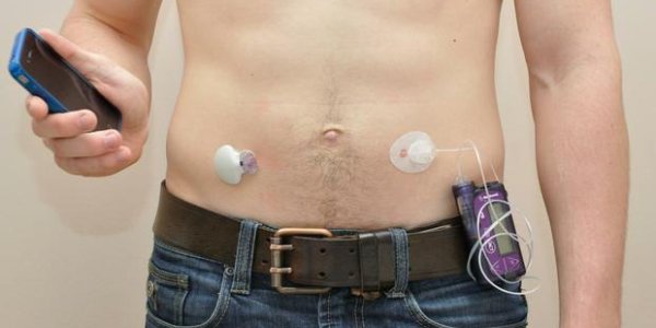 Thanksgiving Science: Artificial Pancreas Improves Treatment Of Type 1 Diabetes