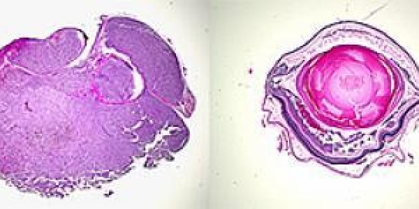 Melanoma Of The Eye Caused By 2 Gene Mutations