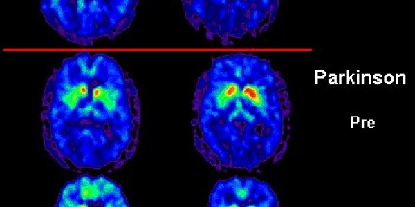 A Yeast Contribution For The Treatment Of Parkinson’s Disease