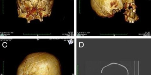 Artificial Cranial Deformation For Social Status Found In Croatia Skulls From 5th Century