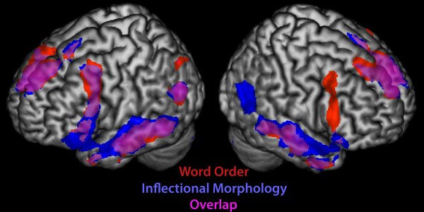 Multiple Brain Regions Wired For Language, Study Finds