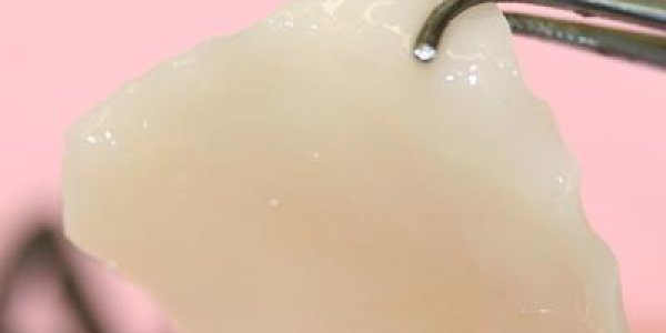 5 Patients Get Nose Reconstruction With Cartilage Grown From Their Own Cells