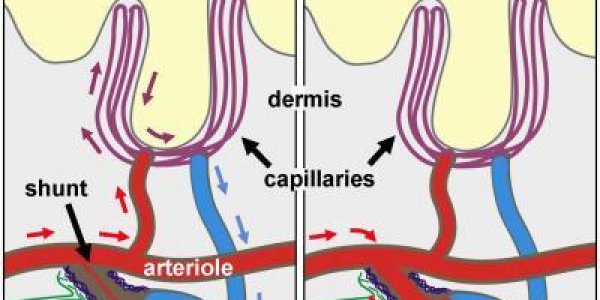 Fibromyalgia Is Not All In The Head, It's In Skin, Paper Concludes