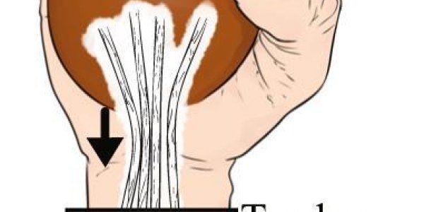 Mechanized Human Hands Improve Function Lost To Nerve Damage