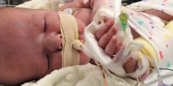 3-D Printer Creates Emergency Trachea Implant, Saves Baby's Life