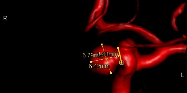 Life Threatening Aneurism - Surgery Monday, Home Tuesday With A Band Aid