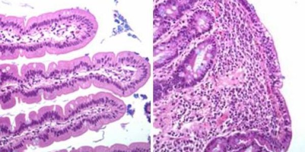 Celiac Disease Diagnosis Gets Simplified