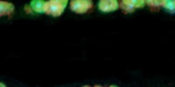 Changes In The Eye Predict Dementia Before Symptoms Show