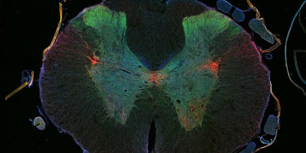 Cancer Drug Epothilone Causes Damaged Nerve Cells In Spinal Cord Injuries To Regrow