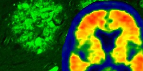 Alzheimer's: Tau, Not Amyloid, Is The Primary Driver