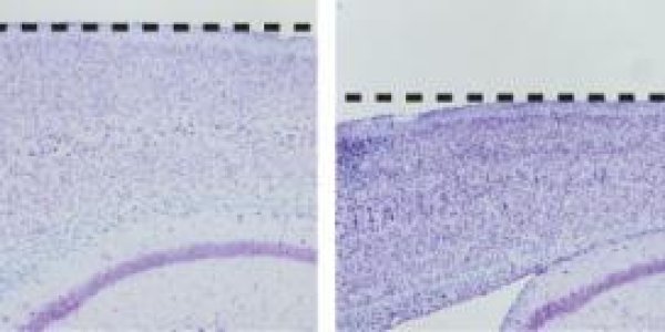 How Genetic Changes Lead To Familial Alzheimer's Disease