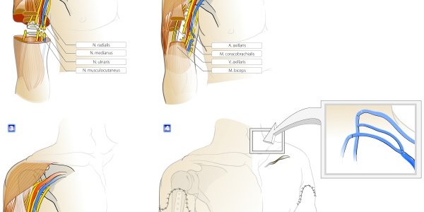 Case History Of The Farmer Who Had A Double Arm Transplant