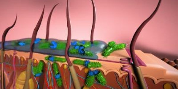Ionic Liquids: Busting Through Biofilm Shatters Defenses Of Serious Skin Infections