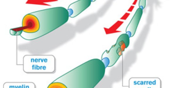 Stem Cell Transplants: Overhyped, But One Huge Benefit May Be Close