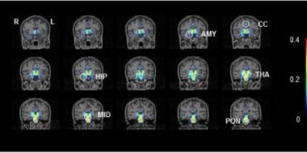 Toward A Clearer Diagnosis Of Chronic Fatigue Syndrome