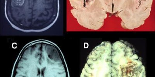 Studying Prefrontal Lobe Damage Unlocks Brain Mysteries