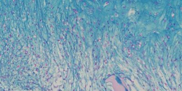 Bio-Engineers Grow Functional Human Cartilage In Vitro