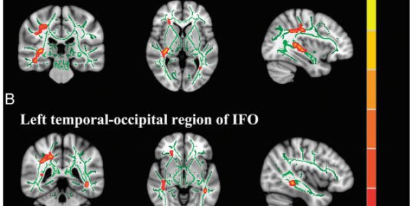 Cough Syrups With Codeine Linked To Brain Deficits