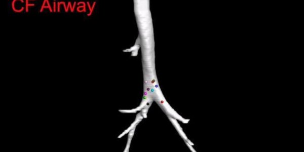 Cystic Fibrosis Mucus Defect Present At Birth