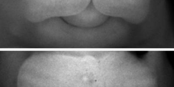 Insights Into Genetics Of Cleft Lip