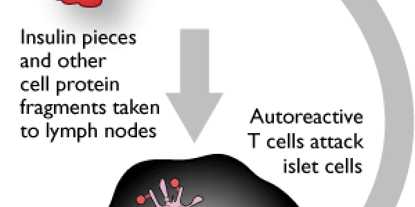 Developing a Vaccine for Type 1 Diabetes