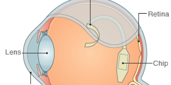 Implanted chip allows blind people to 'see'