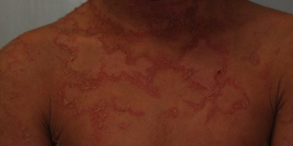 Netherton Syndrome NS Or Bamboo Hair