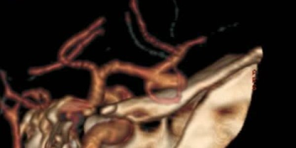 One-third Of All Brain Aneurysms Rupture: The Size Is Not A Significant Risk Factor