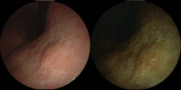 Marker That Identifies Stomach Cancer With Different Progressions Discovered