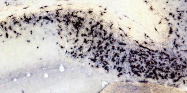 Arginine Deprivation May Be A Potential Cause For Alzheimer's