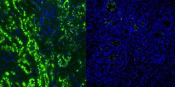 Breaking Down Cancer's Defense Mechanisms