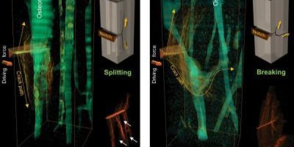 The War On Sunshine Is Leading To More Fragile Bones