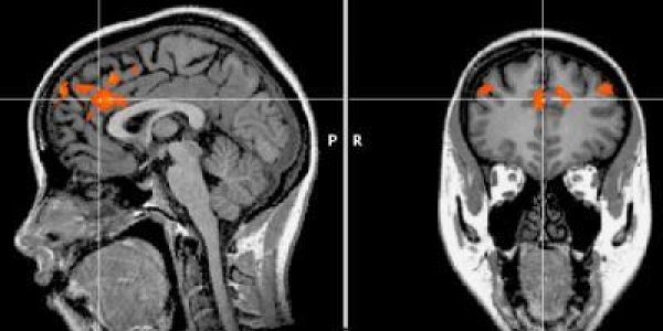 This Is What Your Brain Looks Like When You Lose Control