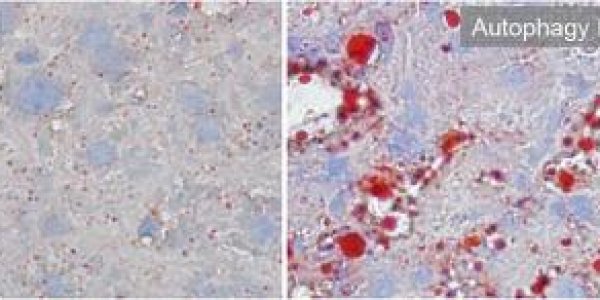 Fight Obesity By Making Fat Cells Eat Themselves