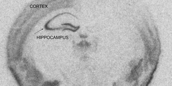 New Hope for Patients with Parkinson's