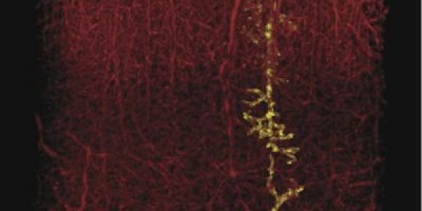 To The Brain, There Is No Such Thing As A Small Stroke - But An Approved Drug Helps