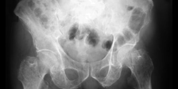 Chronic Pain Isn't All In The Brain