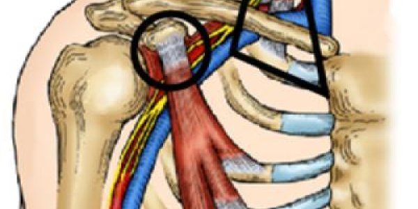 Neurogenic Thoracic Outlet Syndrome: Nerve Compression Disorder  In Athletes Gets New Treatment