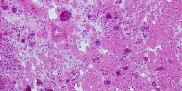 Cell Therapy To Repair Long-Term Muscle Impairment From Sepsis