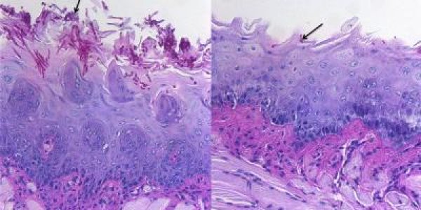 Fighting For Oral Dominance: Good Fungi Keep Bad Ones In Check In Healthy Mouths