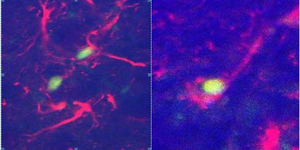 Embryonic Stem Cell Therapy Successful In Reversing Brain Birth Defects In Mice